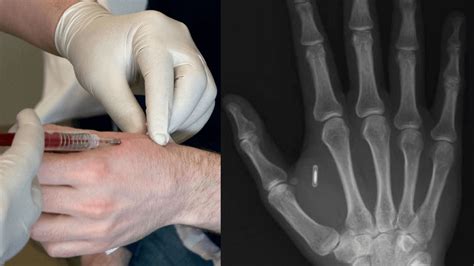 where to get rfid chip implant|RFID & NFC human chip implants .